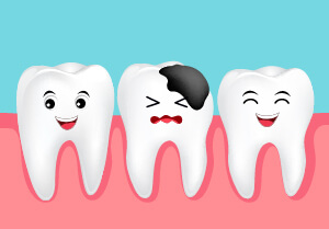 porcelain-veneers-broken-tooth