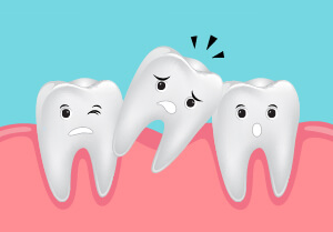 porcelain-veneers-cookedtooth