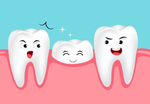 porcelain-veneers-short-tooth