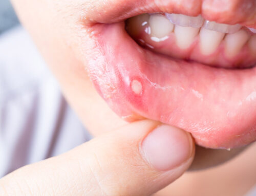 Are Canker Sores a Sign of Poor Dental Hygiene?