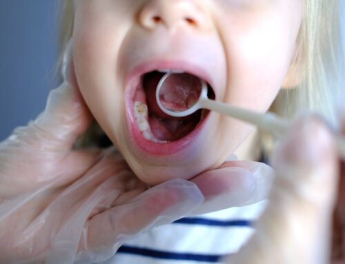 Baby Teeth Get Cavities Too: Here’s Why Early Treamtment Matters
